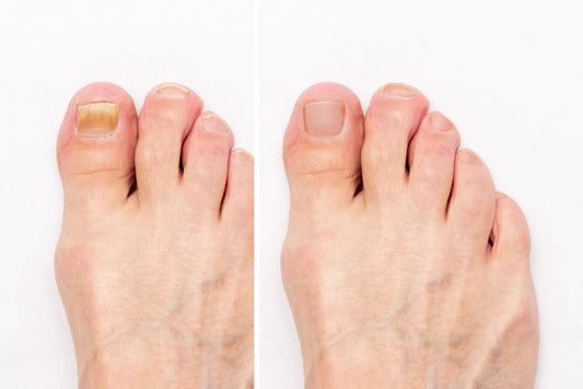 How to Hide Toenail Fungus Instantly — Without Clear Nail Polish
