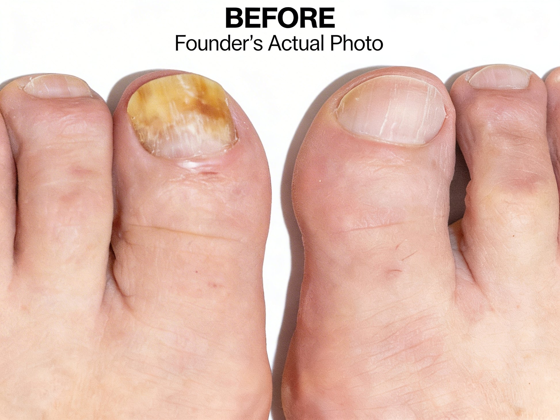 CamoToe Nail Concealer application result - natural matte finish