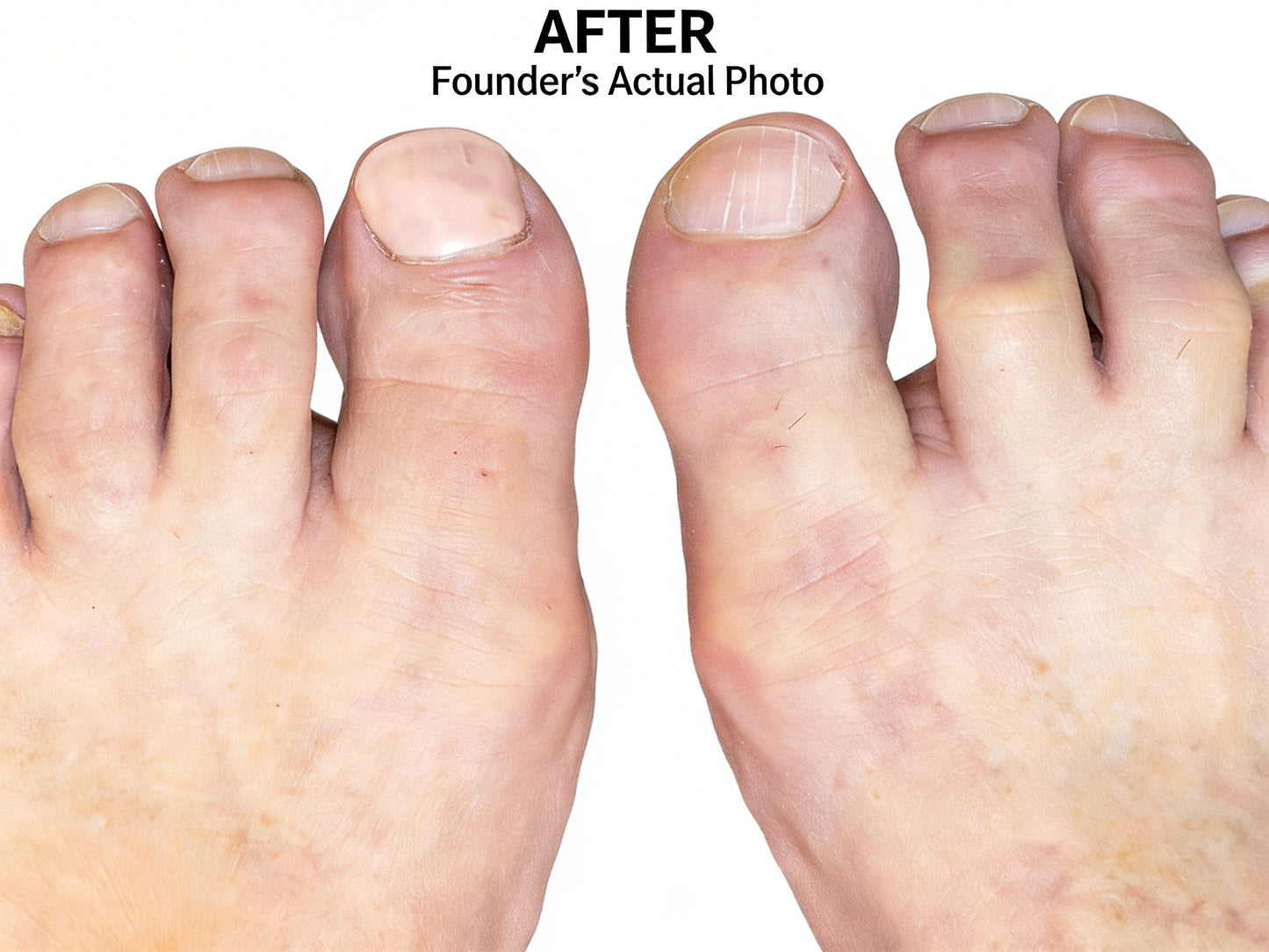 CamoToe Nail Concealer application result - natural matte finish — cosmetic toenail concealer